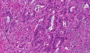 Image result for Adenocarcinoma Rectal Cancer