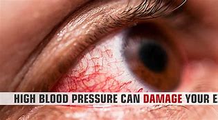 Image result for High Blood Pressure Eye Symptoms