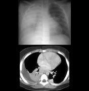 Image result for Thoracic Empyema