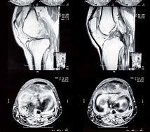 Image result for Normal Knee CT