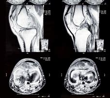 Image result for CT Knee Radiopaedia