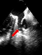 Image result for Cardiac CT Left Atrial Appendage Thrombus