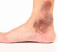 Image result for Skin Darkening Legs