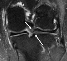 Image result for Knee Joint Meniscus