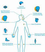 Image result for Acute Ataxia