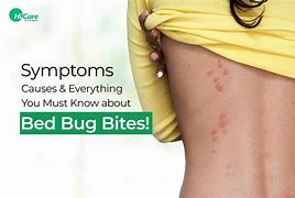 Image result for Big Bed Bug Bites