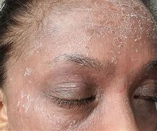 Image result for Eczema On Black Skin with Grey Colour