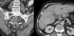 Image result for Adenocarcinoma Rectal Cancer