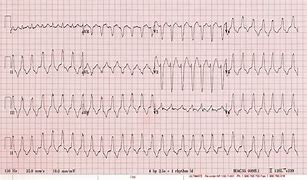 Image result for Polymorphic Wide Complex Tachycardia