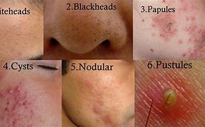 Image result for Deep Acne Cyst