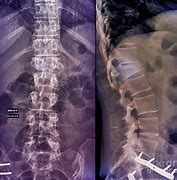 Image result for Imagees Compression Fracture of Lumbar Vertebrae