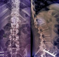 Image result for Compression Fracture Lumbar Surgery