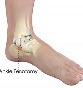 Image result for Heel Cord Tenotomy