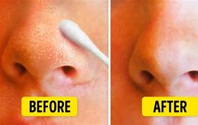 Image result for Blackhead Removal Before and After