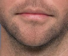 Image result for Pointy Chin Surgery