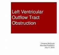 Image result for Left Ventricular Outflow Tract Stroke Volume