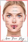 Image result for Acne Boy Face Map