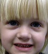 Image result for Malar Hypoplasia