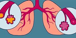 Image result for Sleep Apnea and Asthma