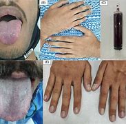 Image result for Cyanosis