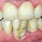 Image result for Tartar Buildup Wisdom Teeth