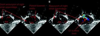 Image result for Right Atrial Appendage Aneurysm