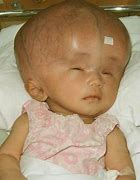 Image result for Hydrocephalus