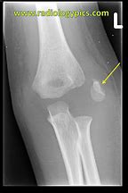 Image result for Avulsion Fracture