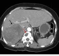 Image result for Pheochromocytoma CT Abdomen