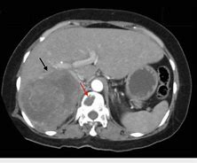 Image result for Pheochromocytoma On CT Scan