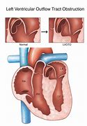 Image result for Left Ventricular Outflow Tract Stroke Volume