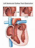 Image result for Anatomical Site of Left Ventricular Outflow Tract