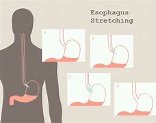 Image result for Esophagus Stretching