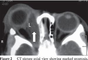 Image result for Subperiosteal Abscess Orbital Cellulitis