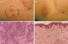 Image result for Squamous and Basal Cell Cancer