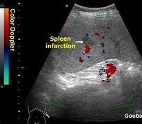 Image result for Spleen Infarction Ultrasound