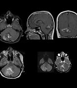 Image result for Medulloblastoma Location Diagram