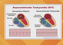 Image result for SVT Bongie