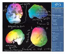 Image result for SPECT Scan