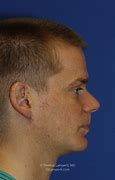 Image result for Mentoplasty