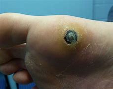 Image result for Plantar Wart On Kids Foot