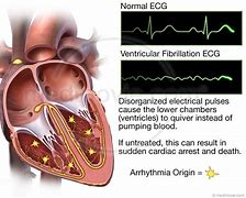 Image result for Ventricular Fibrillation Symptom