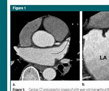 Image result for Right Atrial Appendage Thrombus