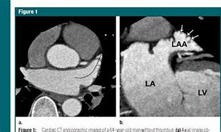 Image result for Cardiac CT Left Atrial Appendage Thrombus