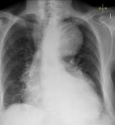 Image result for Aortic Rupture CXR