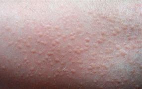 Image result for Hives with Pustules