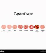 Image result for Pustules and Papules On Face