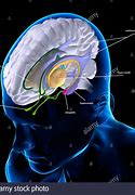 Image result for CT Brain Lentiform Nucleus