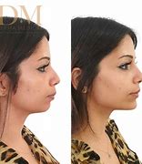 Image result for Chin Correction Filler