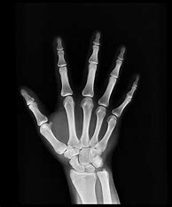 Image result for Child's Hand X-ray